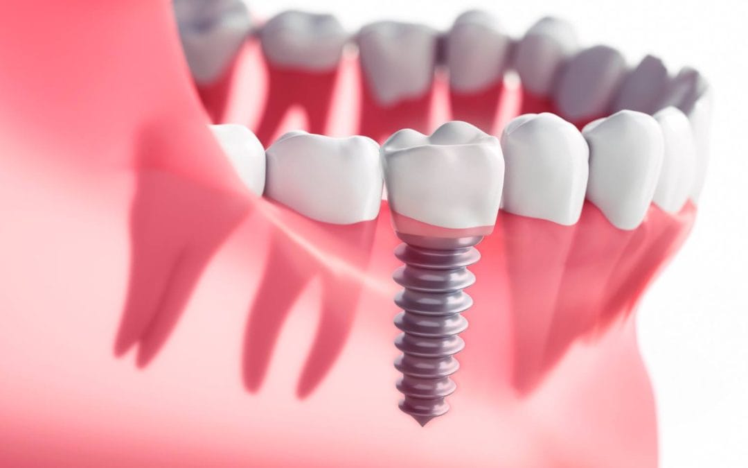 What are dental implants – and why choose them?