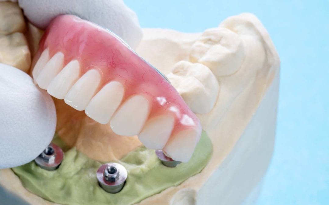 Dentures or implants? Which is right for you?