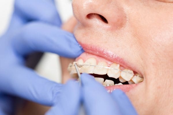 Invisible braces being fixed on a womans teeth
