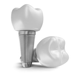 components of dental implants