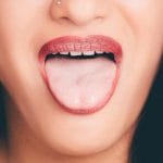 woman with mouth open showing dry mouth