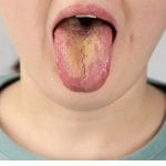 close up of oral thrush on the tongue