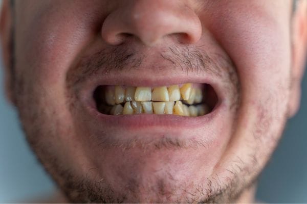 Close of man's mouth with discoloured teeth