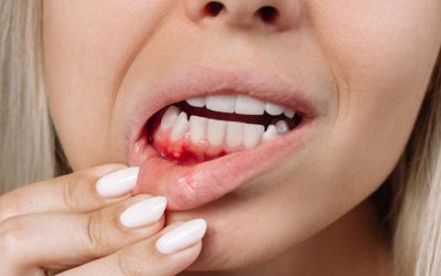 Bleeding Gums: How To Prevent & Treat Gum Disease
